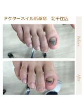 ドクターネイル爪革命 北千住店/肥厚爪・変形爪ケア