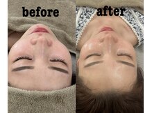 マホロバ(mahoroba)/美容鍼×ララピールmahoroba