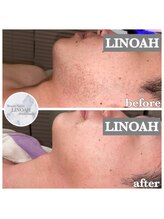 リノア 心斎橋店(LINOAH)/男性ヒゲ脱毛　b → a