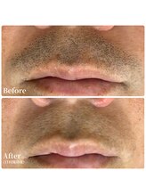 エース(ACE.)/時短&清潔感UP☆ヒゲ脱毛