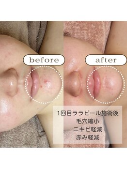 ゼニス 池袋本店(ZENITH)/肌荒れもしっかりケア☆