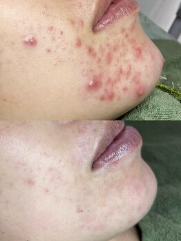 イベリス(Iberis)/ハーブピーリング/ニキビケア