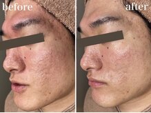 ホワイトアクア 浜松店(WHITE AQUA)/ララピール/ニキビケア