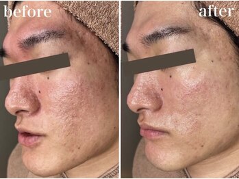 ホワイトアクア 浜松店(WHITE AQUA)/ララピール/ニキビケア