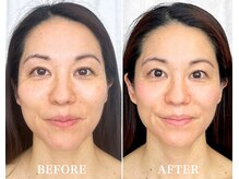 顔の歪みを改善。左右対称のお顔、中顔面を短く小顔へ