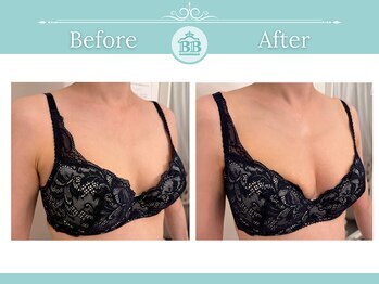 美人バスト 新潟店/ 【バストアップ★育乳】症例