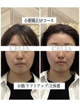 セリア(CELIA)/小顔矯正/小顔//面長/エラ張り