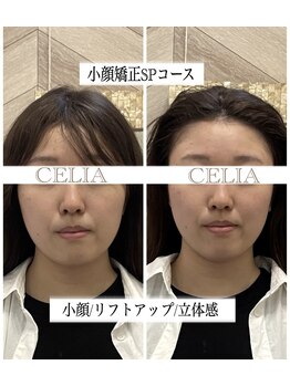 セリア(CELIA)/小顔矯正/小顔//面長/エラ張り