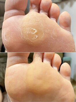 アンジェヴォーグ 名古屋本店(Angevogue)の写真/新栄駅徒歩2分！【すべすべ角質ケアコース¥5500】ガサガサかかともツルツルに♪