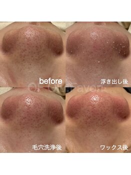 オフオルファヴォリ(OF Olu:Favori)/before after