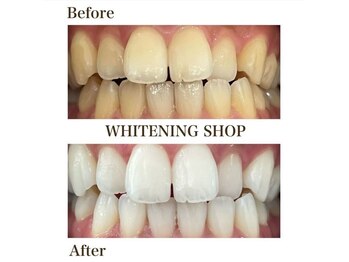 ホワイトニングショップ 富山店/【Before After】
