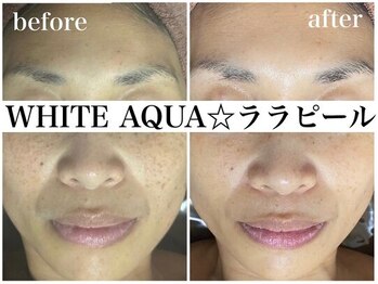 ホワイトアクア 姫路店(WHITE AQUA)/ララピール/シミ/エイジングケア