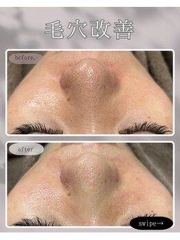 レア 姫路店(le'a)/毛穴悩みの改善