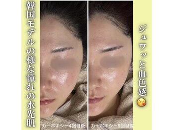 ハニエル(Haniel)/カーボキシー症例