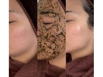 シェリエ(CHERIE)/ハーブピーリング