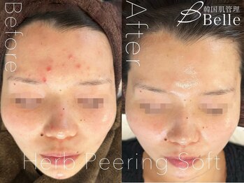 ベル 熊本店(Belle)/ハーブピーリング|ニキビケア