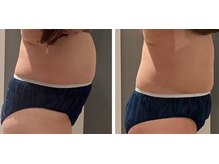 フォルチェ はません店(Folche)/ぽっこりお腹