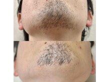 ヒゲ施術7回の様子です！