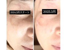 マリア(MALIA)の雰囲気（細かい部分まで照射できる肌に優しいシミペン！照射後メイクok！）