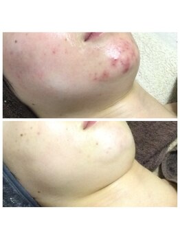 リラーナ(Re rana)/大人ニキビケア♪