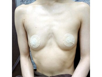 ルミエール(Lumiere)/【倉敷市】バストアップ施術事例