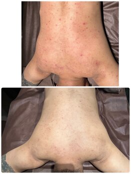 ミラヴィエ(Miravie)/男性背中ニキビケア