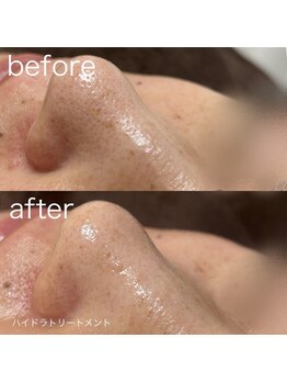ルルラ リコ(lulula rico)/症例写真/毛穴洗浄