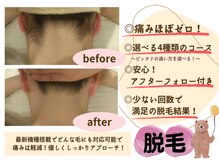 アンドモア(&more)/気になる箇所のパーツ脱毛が人気