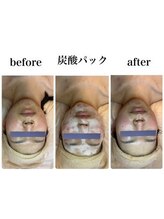 KMB 中崎町店/肌改善3点SET☆