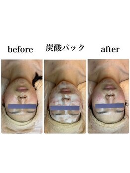 KMB 中崎町店/肌改善3点SET☆