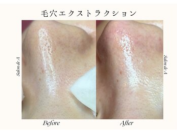 サロンドエー 帝塚山(Salon de A)/シミケア!?