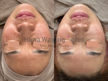 ハナワクシングプラス 高知(HanaWaxing+)/【プラズマワックス(CSP)】