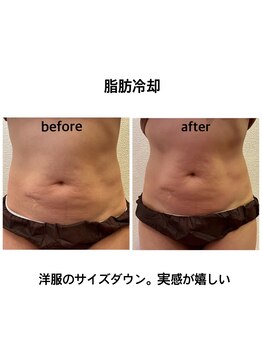 ワールドアイ(World. I)/脂肪冷却