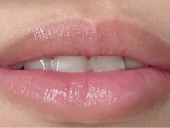 フー(Who?)の写真/誰にも言えない黒ずみの悩み、もう隠さない。韓国発ローマピンクで、唇/乳輪/VIOも本来のピンク肌へ☆