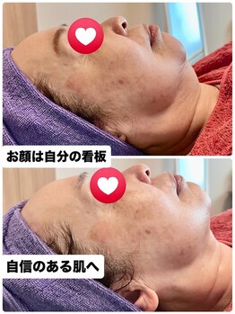 ローズ 下松(ROSE)/ほうれい線マリオネット線に