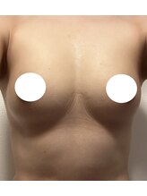 ルミエール(Lumiere)/【倉敷市】バストアップ施術事例