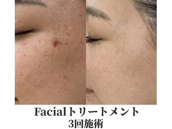 アムリリー 南草津店(AMRILY)/肌質改善