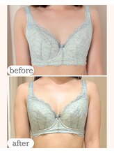 ワム(Wom)/30代/月2回施術3ヶ月経過