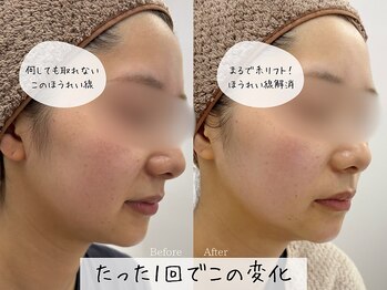 リルビューティーラボ(LILU BEAUTY LAB)の写真/切らずに小顔へ◎韓国人気の《オンリフト》で二重あご・もたつきに◎理想のフェイスライン&スッキリ小顔に