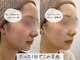 リルビューティーラボ(LILU BEAUTY LAB)の写真/切らずに小顔へ◎韓国人気の《オンリフト》で二重あご・もたつきに◎理想のフェイスライン&スッキリ小顔に