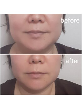 エルアンドエス(L&S)/ヒト幹細胞×特殊美容鍼