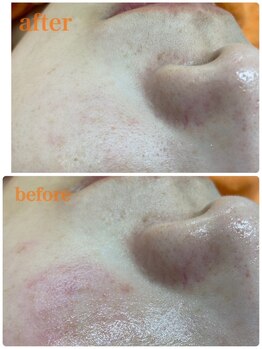 ドマーニプラス 泉店(DOMANI PLUS.)/ミルクピールで毛穴ケア