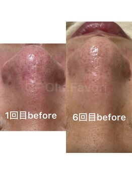 オフオルファヴォリ(OF Olu:Favori)/before after