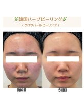 バブル(BUBRU)/グロウパールピーリング(ハーブ)