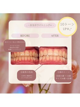 プラスビーセルフ(+b self)/ホワイトニングビフォーアフター