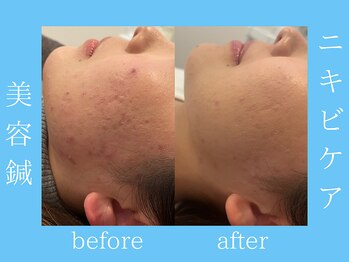 ビープラス(BEE PLUS)/20代女性 ニキビケア