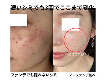 エイチケービューティーサロン(H/K beauty salon)/【濃いシミもここまで変化】