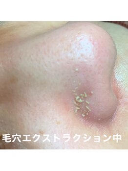 シェソワ(Chez soi)/毛穴エクストラクションについて