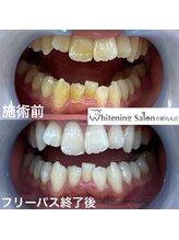ホワイトニングサロン 京都烏丸店/ホワイトニング施術例