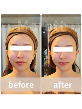 マロット 表参道店(Marott)/【30代女性】瞬間小顔リフト♪